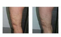 Sclerotization of varicose veins - Photo before - ARS ESTETICA – Klinika Medycyny Estetycznej i Laseroterapii