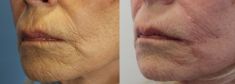 Injekční výplně - fotka před - MUDr. Evžen Trupar Ph.D.