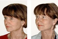 Hyaluronic acid-based wrinkle fillers - Photo before - Dr. Dobos Calin