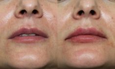 Lip augmentation - cheiloplasty - Photo before - ARS ESTETICA – Klinika Medycyny Estetycznej i Laseroterapii