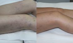 Sclerotization of varicose veins - Photo before - ARS ESTETICA – Klinika Medycyny Estetycznej i Laseroterapii