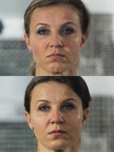 Mezonite - Fotka pred - ENVY klinika estetickej medicíny
