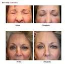 Botox/Dysport - Eliminar arrugas - Foto Antes de - CLINICA DENTAL ART
