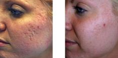 Radiofrequency Rejuvenation (Aluma, accent, TriPollar, Spa RF device, Re-Age) - Photo before - Klinika Laser Esthetic