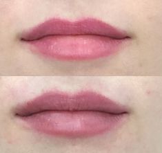 Lip augmentation - cheiloplasty - Photo before - ARS ESTETICA – Klinika Medycyny Estetycznej i Laseroterapii