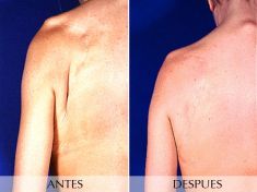Lipotransferencia de grasa (lipofiling) - Foto Antes de - Clínica Planas