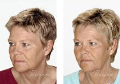 Hyaluronic acid-based wrinkle fillers - Photo before - Dr. Dobos Calin