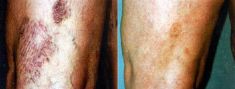 Varicose veins treatment - Photo before - Dr. Dobos Calin