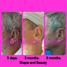 Liposucción - Foto Antes de - Dr. Marco Antonio Carmona M.D.