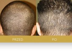Hair Transplant - Photo before - Dr Turowski Hair Restoration Clinic