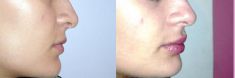 Lip augmentation - cheiloplasty - Photo before - Dr. Dobos Calin