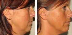 Radiofrekwencja (urzadzenie Aluma, Accent, TriPollar, Spa RF, Pelleve) - Zdjęcie przed - Bieńkowscy Clinic®