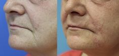 Injekční výplně - fotka před - MUDr. Evžen Trupar Ph.D.