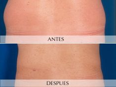 Liposucción - Foto Antes de - Clínica Planas