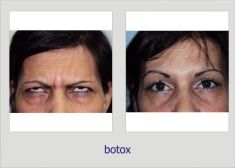 Botulinum toxin - Wrinkle Removal - Photo before - Dr. Lucian Fodor PhD