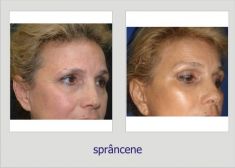 Brow lift - Photo before - Dr. Lucian Fodor PhD