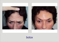 Botulinum toxin - Wrinkle Removal - Photo before - Dr. Lucian Fodor PhD