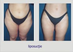 Liposuction - Photo before - Dr. Lucian Fodor PhD