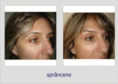 Brow lift - Photo before - Dr. Lucian Fodor PhD