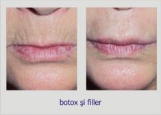 Botulinum toxin - Wrinkle Removal - Photo before - Dr. Lucian Fodor PhD