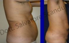 Liposuzione - Foto del prima - Dott. Salvatore Scandura M.D.