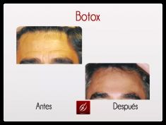 Botox/Dysport - Eliminar arrugas - Foto Antes de - Dr. Aristides Arellano-Huacuja