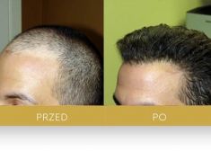 Hair Transplant - Photo before - Dr Turowski Hair Restoration Clinic
