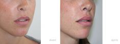 Injections d