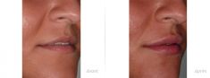 Injections d
