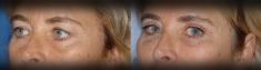 Blépharoplastie - Cliché avant - Dr Hervé Raspaldo