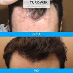 Hair Transplant - Photo before - Dr Turowski Hair Restoration Clinic