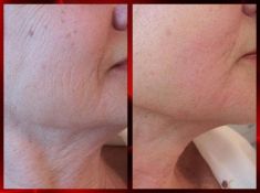 Radiofrequenza estetica – apparecchiature Aluma, Accent, TriPollar, Spa RF, Re-Age - Foto del prima - Dott. Dario Rochira