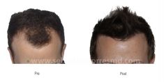 Trapianto capelli - Foto del prima - Dott. Sebastian Torres Farr