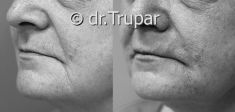 Injekční výplně - fotka před - MUDr. Evžen Trupar Ph.D.