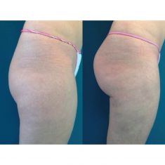 Zväčšenie a modelácia zadočku a bokov - Fotka pred - ENVY klinika estetickej medicíny