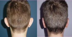 Ear surgery (Otoplasty) - Photo before - Dr. Dobos Calin