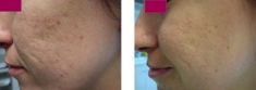 Radiofrequency Rejuvenation (Aluma, accent, TriPollar, Spa RF device, Re-Age) - Photo before - Klinika Laser Esthetic