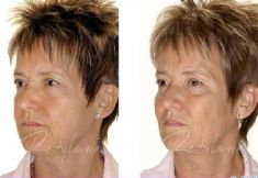 Hyaluronic acid-based wrinkle fillers - Photo before - Dr. Dobos Calin