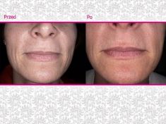 Kwas hialuronowy: Saypha, Restylane, Juvederm, Stylage - Zdjęcie przed - Klinika Wiatroszak - ESTmedica