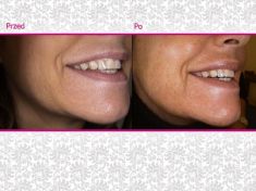 Kwas hialuronowy: Saypha, Restylane, Juvederm, Stylage - Zdjęcie przed - Klinika Wiatroszak - ESTmedica