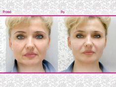 Kwas hialuronowy: Saypha, Restylane, Juvederm, Stylage - Zdjęcie przed - Klinika Wiatroszak - ESTmedica