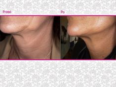 Kwas hialuronowy: Saypha, Restylane, Juvederm, Stylage - Zdjęcie przed - Klinika Wiatroszak - ESTmedica