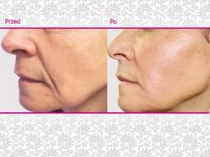 Kwas hialuronowy: Saypha, Restylane, Juvederm, Stylage - Zdjęcie przed - Klinika Wiatroszak - ESTmedica