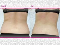 Liposukcja (odsysanie tłuszczu) - Zdjęcie przed - Klinika Wiatroszak - ESTmedica