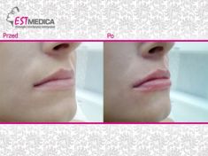 Powiększanie ust (Augmentacja) - Zdjęcie przed - Klinika Wiatroszak - ESTmedica