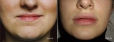 Augmentation des lèvres par Permalip - Cliché avant - Dr Franck Ouakil