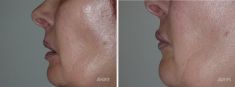 Augmentation des lèvres par Permalip - Cliché avant - Dr Franck Ouakil