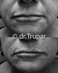 Injekční výplně - fotka před - MUDr. Evžen Trupar Ph.D.
