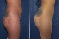 Aumento y Modelado de Glúteos - Foto Antes de - Dra. Ana Martinez Padilla