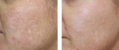 Radiofrequency Rejuvenation (Aluma, accent, TriPollar, Spa RF device, Re-Age) - Photo before - Klinika Laser Esthetic
